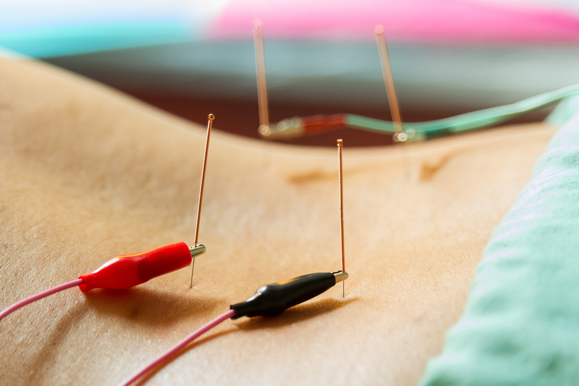 Electro Dry Needling – EP Bodywork Therapy